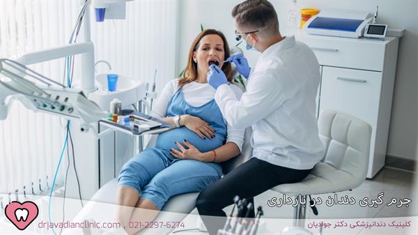 جرم گیری دندان در بارداری