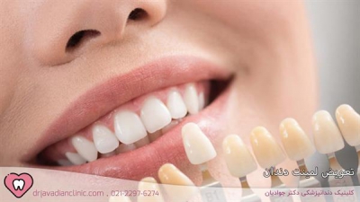 ترمیم یا برداشتن لمینت دندان | آیا تعویض لمینت امکان پذیر است؟