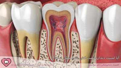 آیا لمینت دندان عصب کشی شده ممکن است؟ | نحوه انجام و مزایا