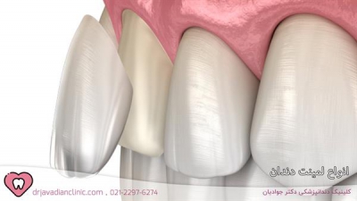 انواع لمینت سرامیکی دندان | 2 عامل مهم در انتخاب انواع لمینت