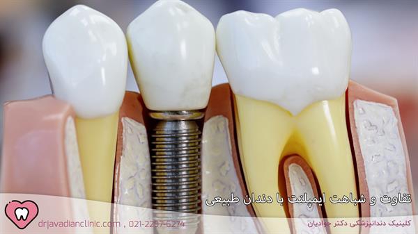 تفاوت و شباهت ایمپلنت با دندان طبیعی