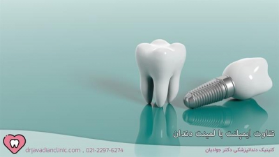 تفاوت ایمپلنت و لمینت دندان