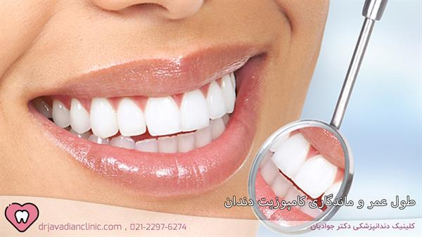 طول عمر و ماندگاری کامپوزیت دندان چقدر است؟ + 4 روش افزایش دوام